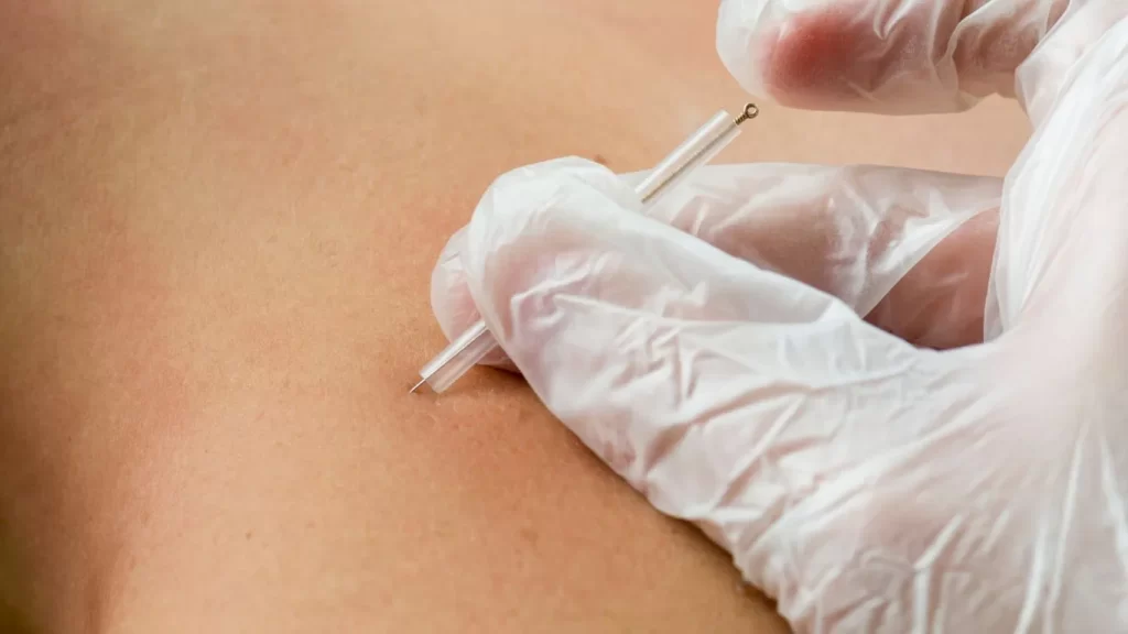 dry-needling-technique-shown-by-doctor